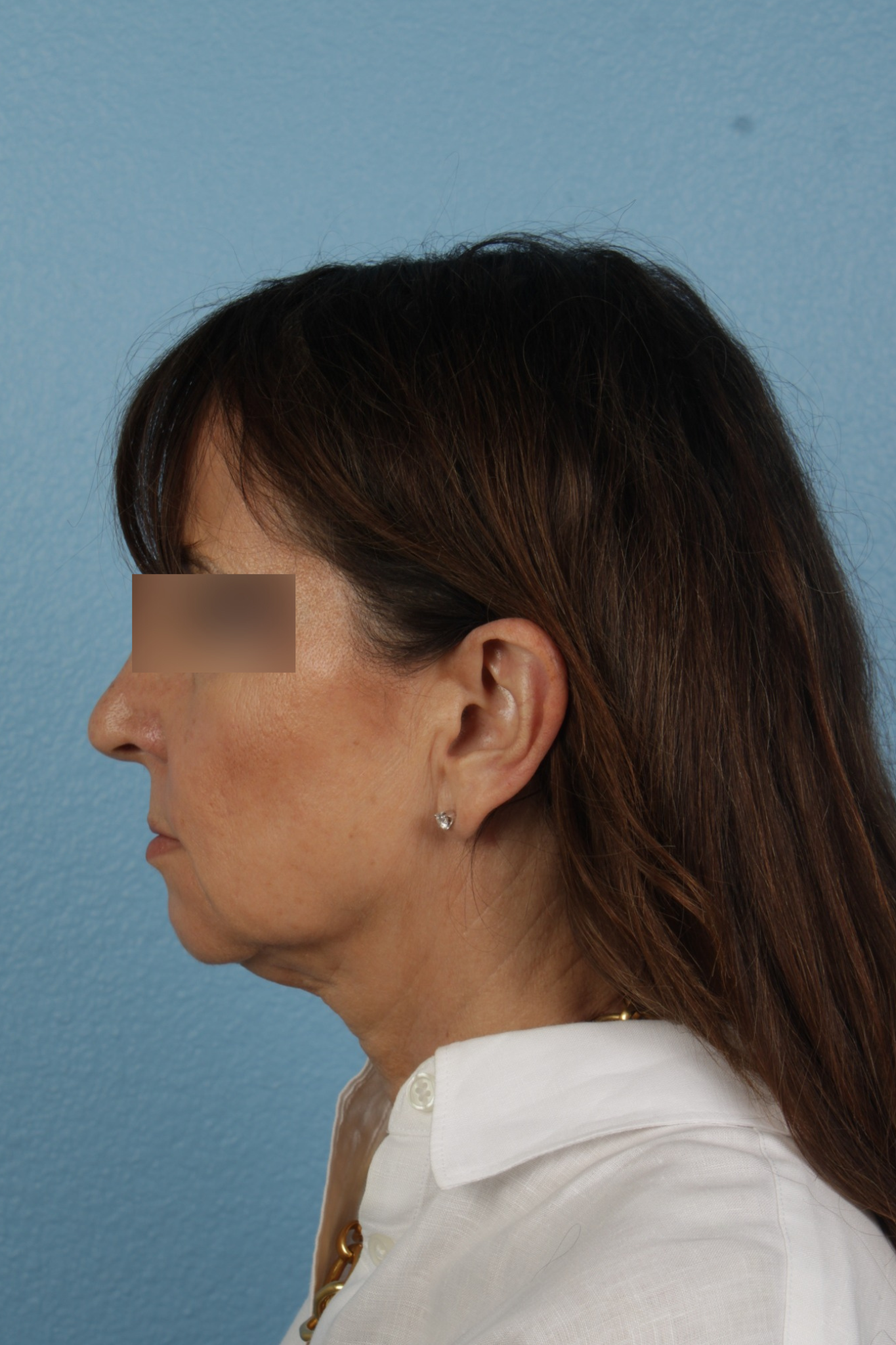 Facelift Before & After Gallery - Patient 407291 - Image 9