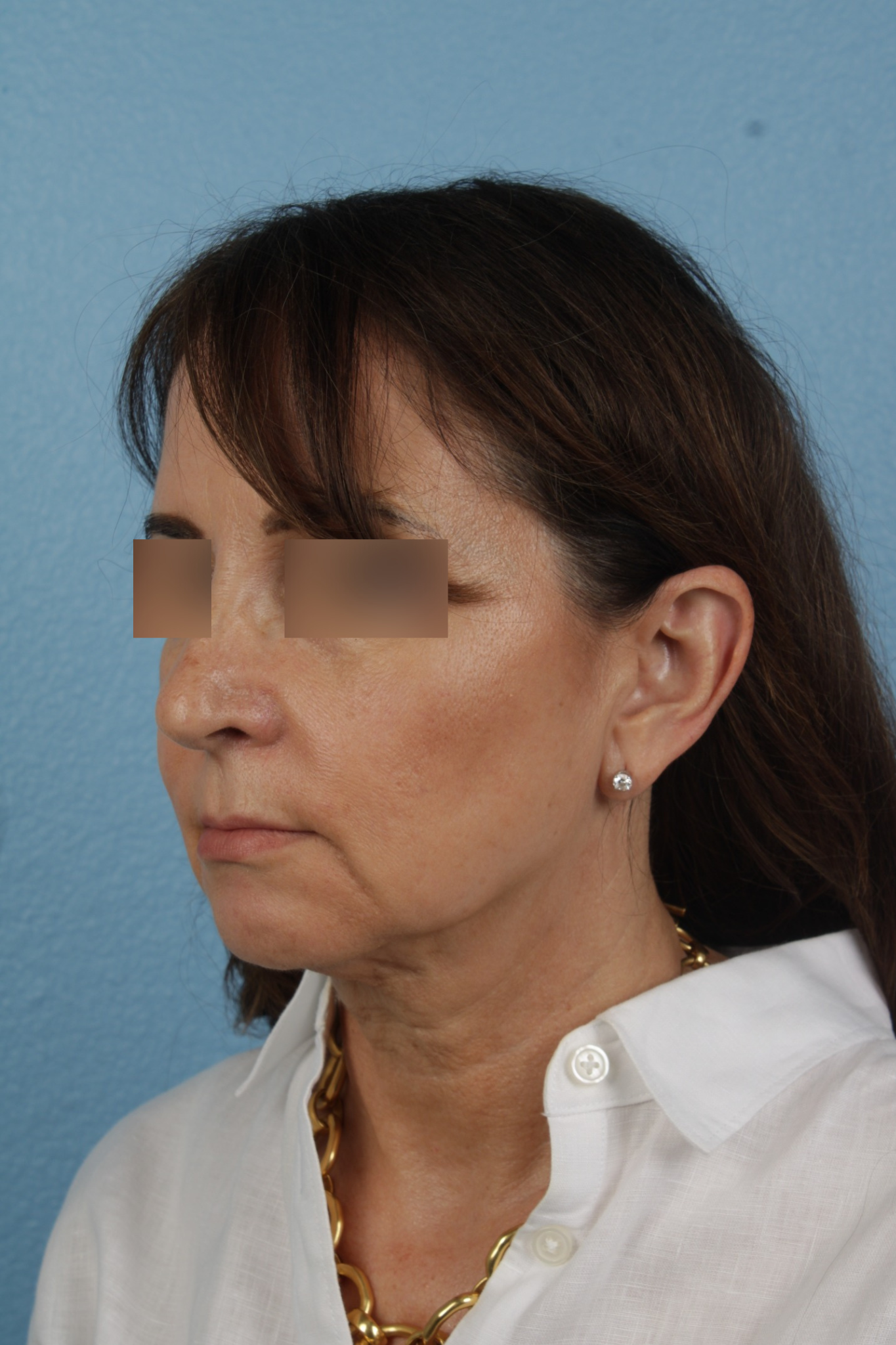 Facelift Before & After Gallery - Patient 407291 - Image 7