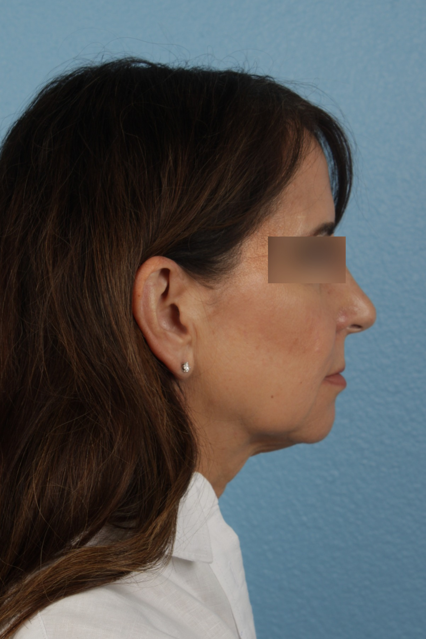 Facelift Before & After Gallery - Patient 407291 - Image 5