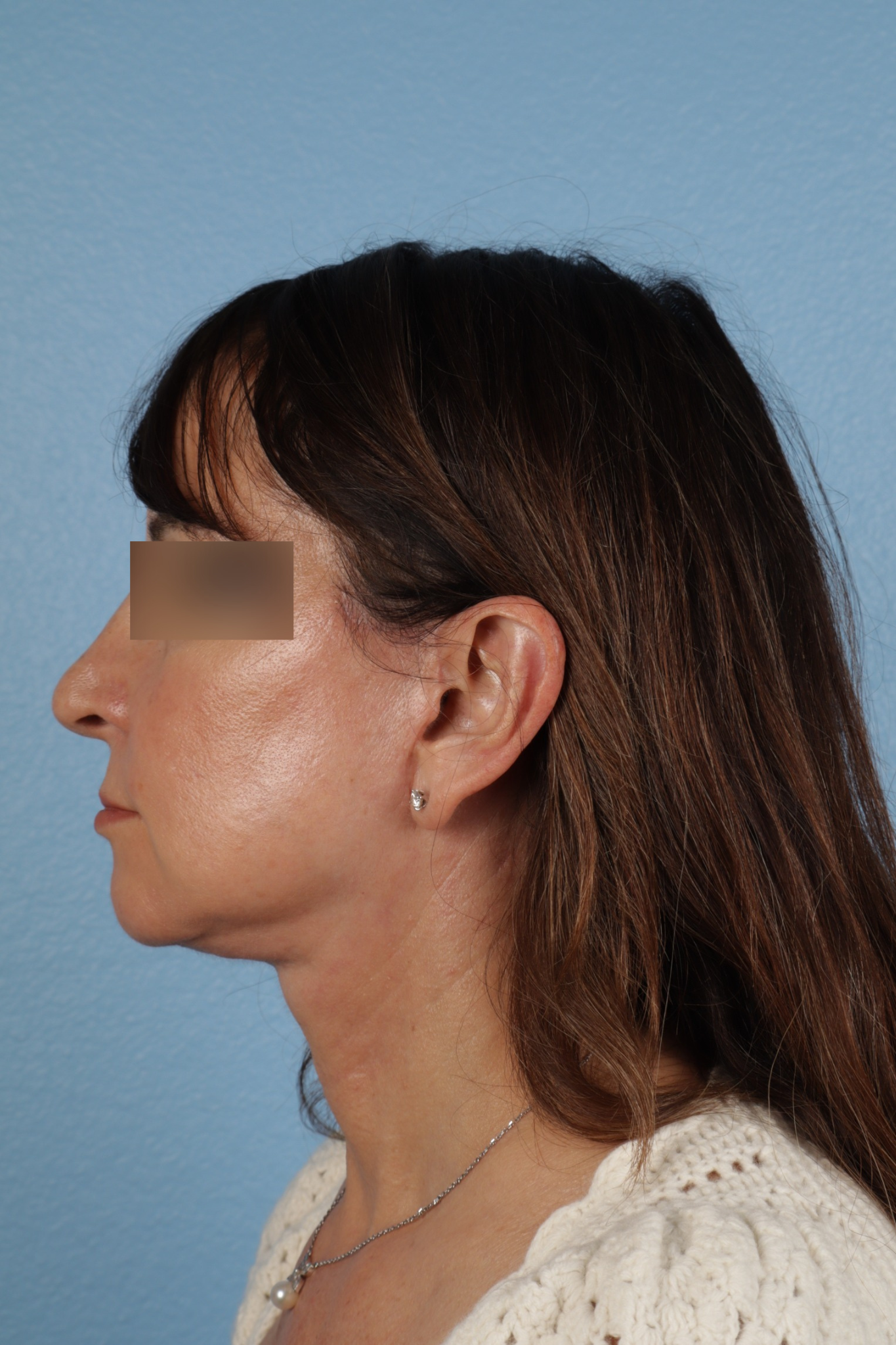 Facelift Before & After Gallery - Patient 407291 - Image 10
