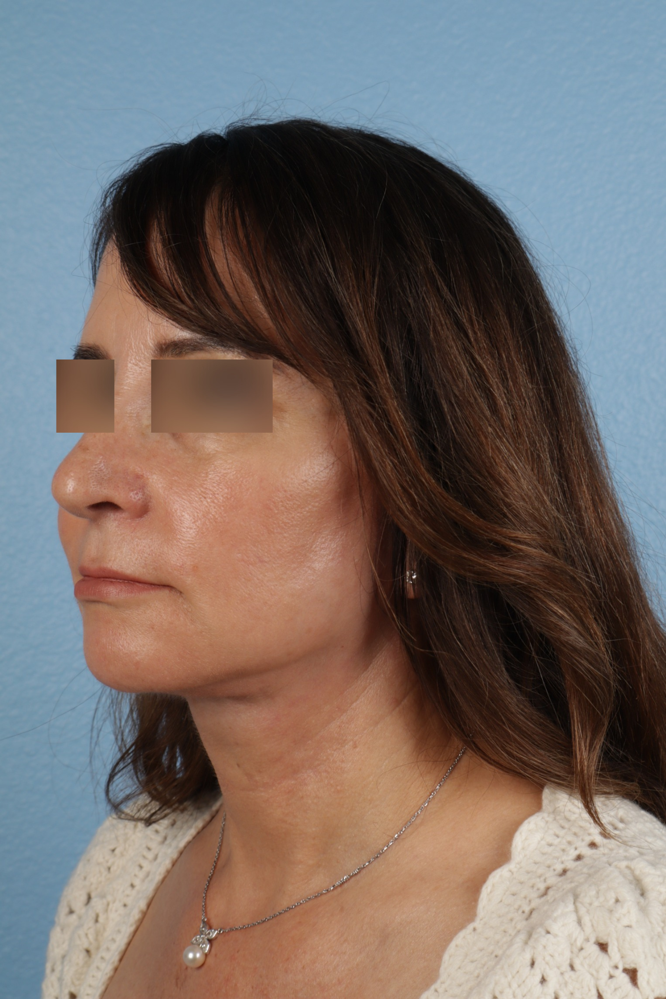Facelift Before & After Gallery - Patient 407291 - Image 8