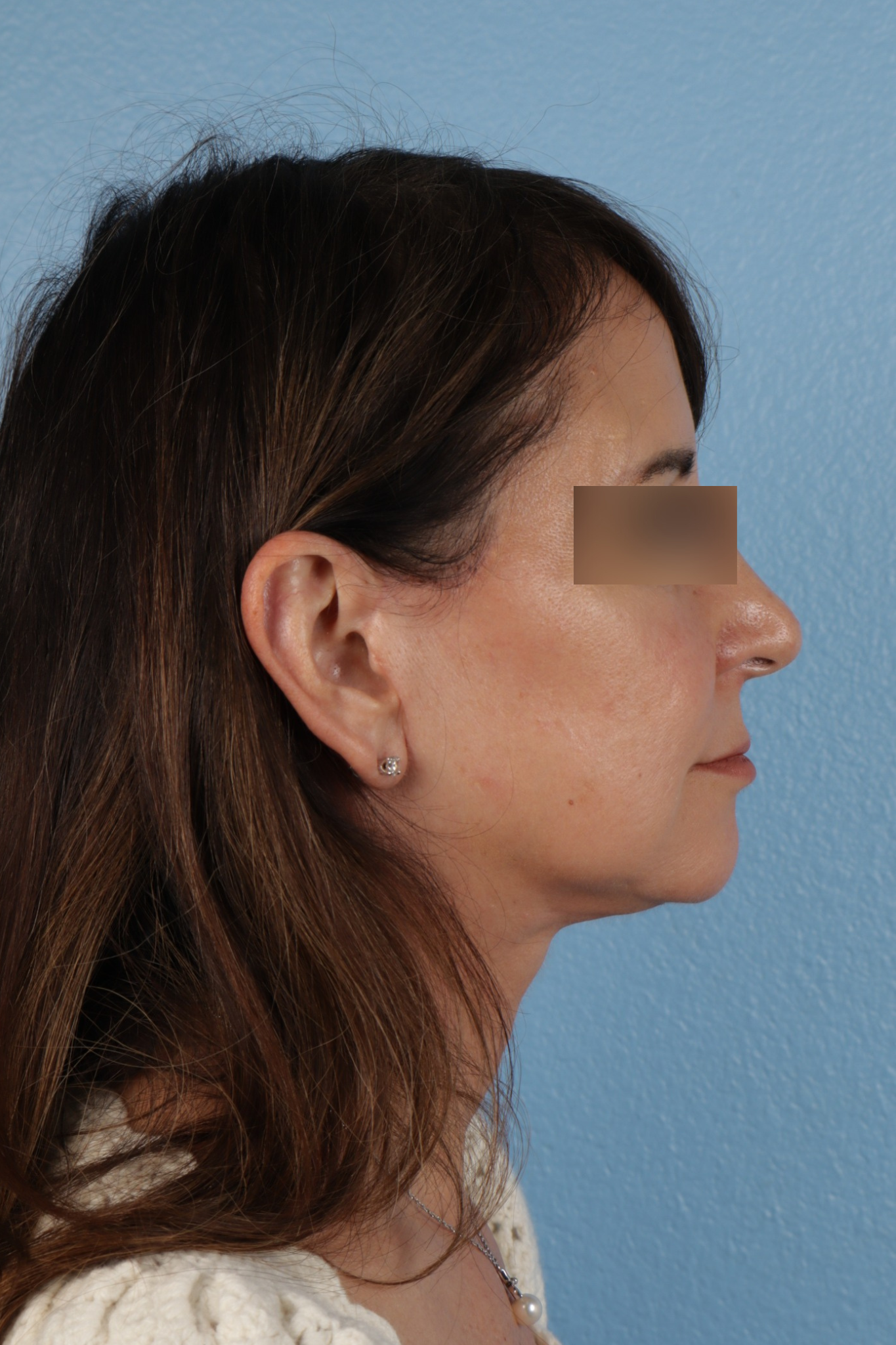 Facelift Before & After Gallery - Patient 407291 - Image 6