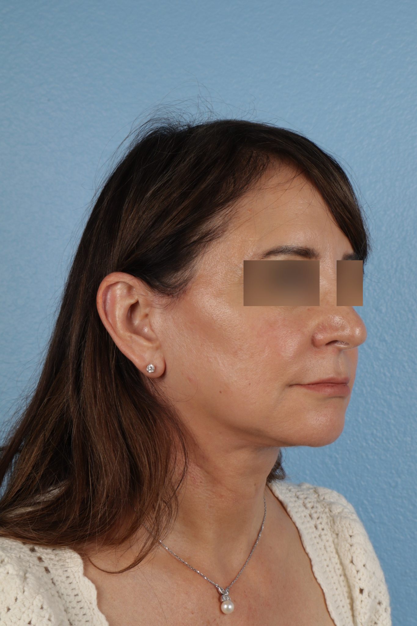 Facelift Before & After Gallery - Patient 407291 - Image 4