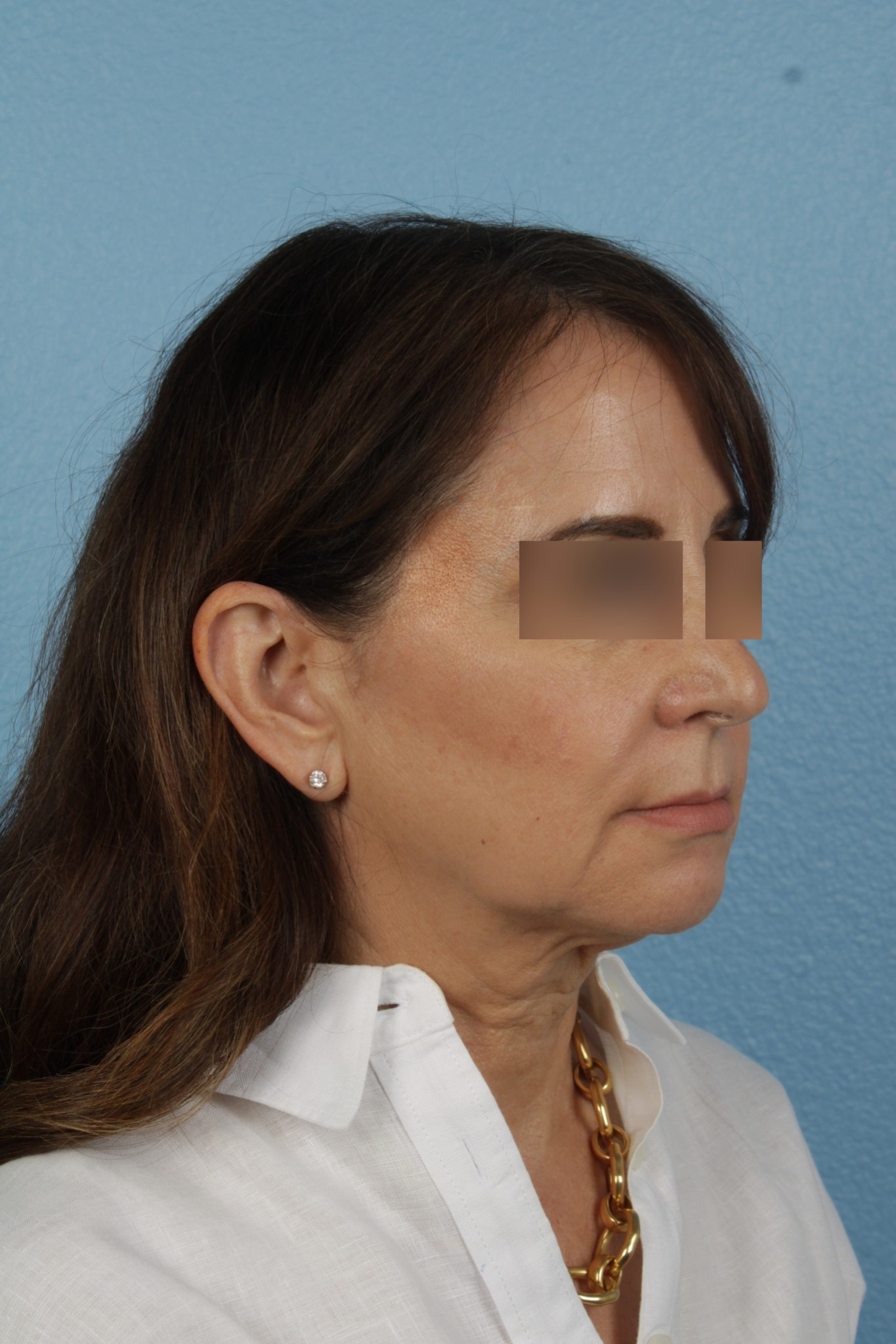 Facelift Before & After Gallery - Patient 407291 - Image 3