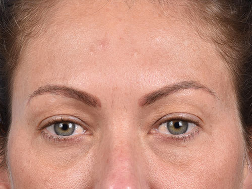 Blepharoplasty Before & After Gallery - Patient 213842 - Image 1