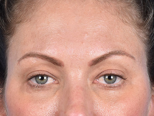 Blepharoplasty Before & After Gallery - Patient 213842 - Image 2