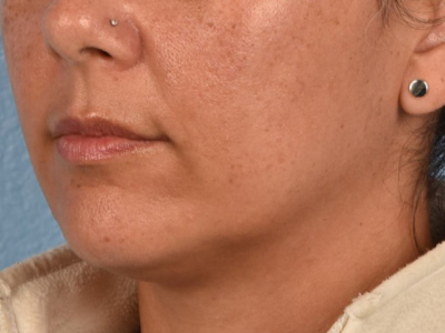 Lip Lift Before & After Gallery - Patient 191794 - Image 1