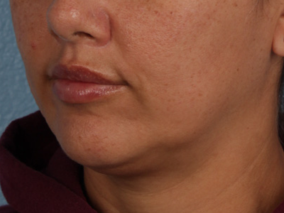 Lip Lift Before & After Gallery - Patient 191794 - Image 2