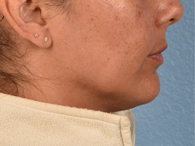 Lip Lift Before & After Gallery - Patient 191794 - Image 3