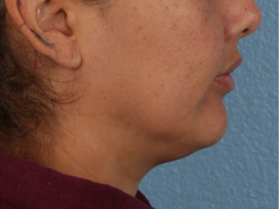 Lip Lift Before & After Gallery - Patient 191794 - Image 4