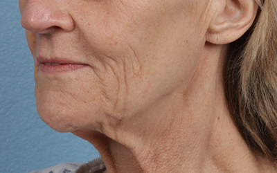 Lip Lift Before & After Gallery - Patient 340858 - Image 1