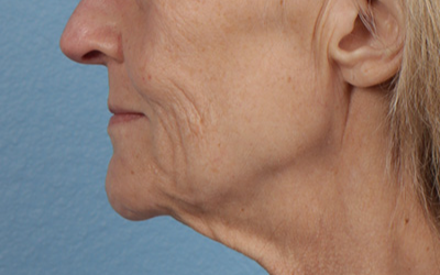 Lip Lift Before & After Gallery - Patient 340858 - Image 3
