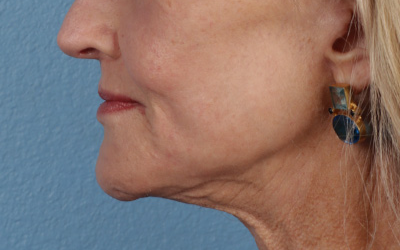 Lip Lift Before & After Gallery - Patient 340858 - Image 4