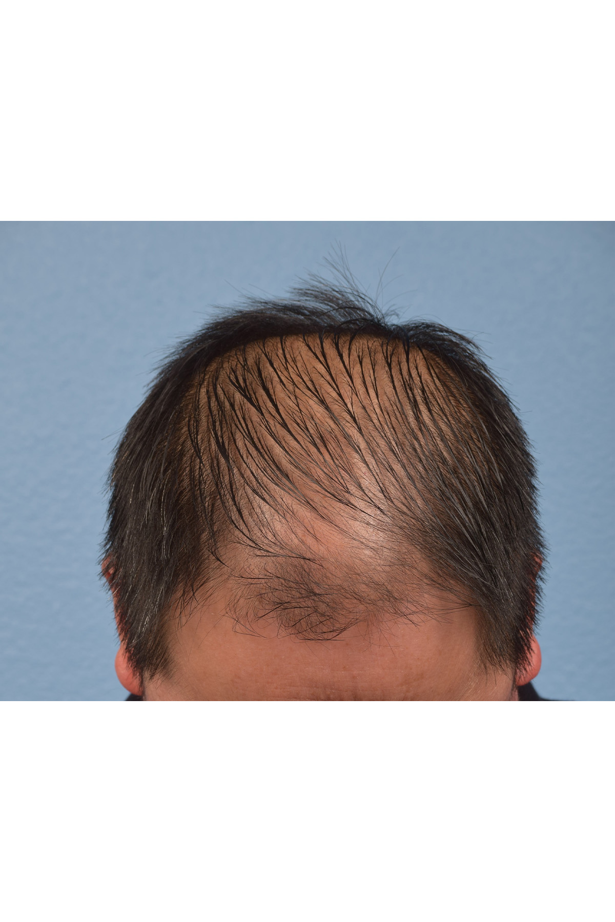 Hair Transplant With NeoGraft Before & After Gallery - Patient 242971 - Image 1