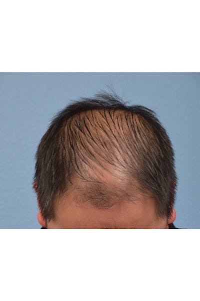 Hair Transplant With NeoGraft Before & After Gallery - Patient 242971 - Image 1