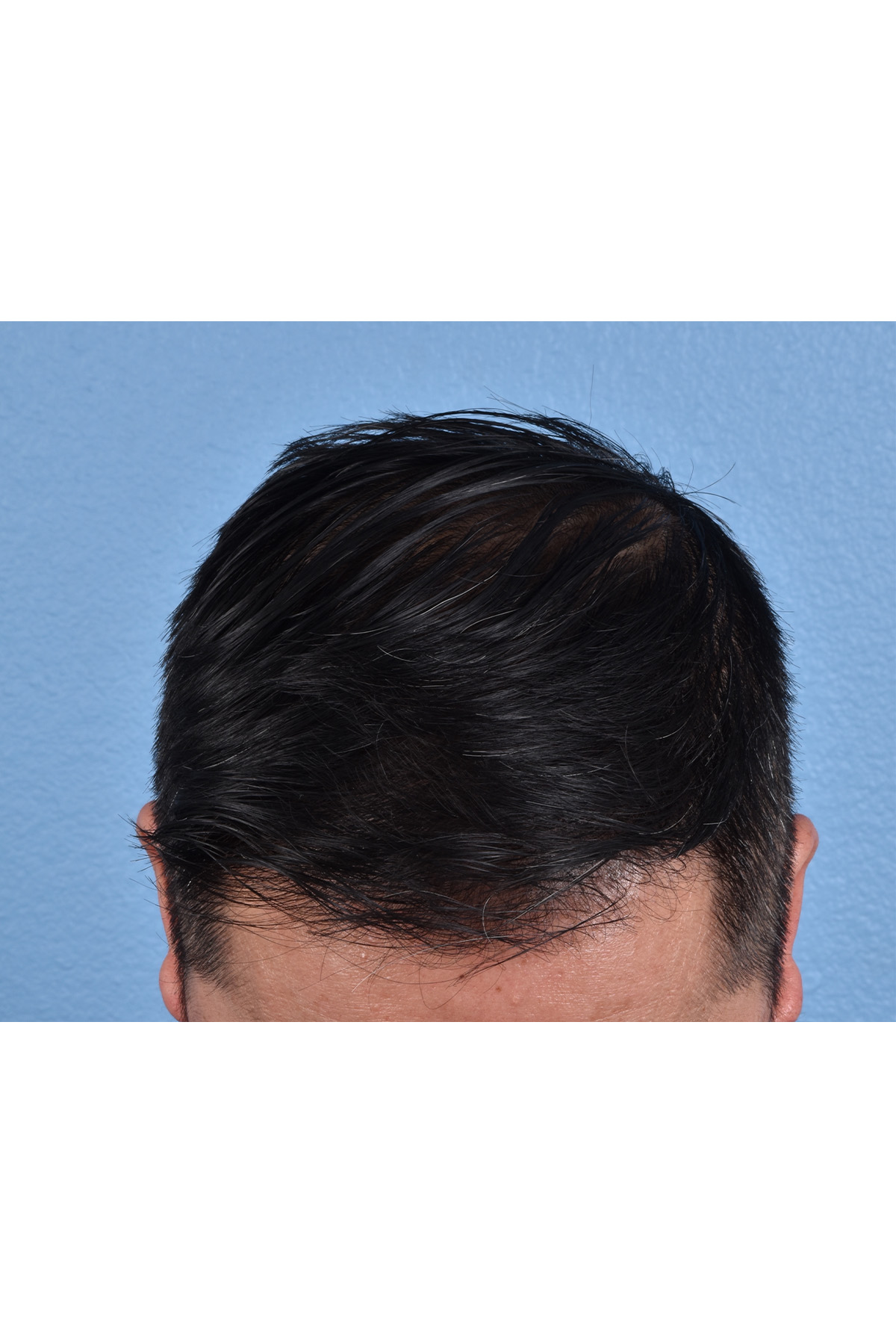 Hair Transplant With NeoGraft Before & After Gallery - Patient 242971 - Image 2