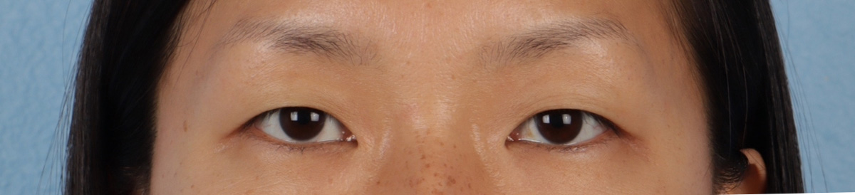 Blepharoplasty Before & After Gallery - Patient 871559 - Image 1