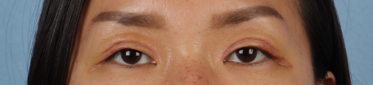 Blepharoplasty Before & After Gallery - Patient 871559 - Image 2