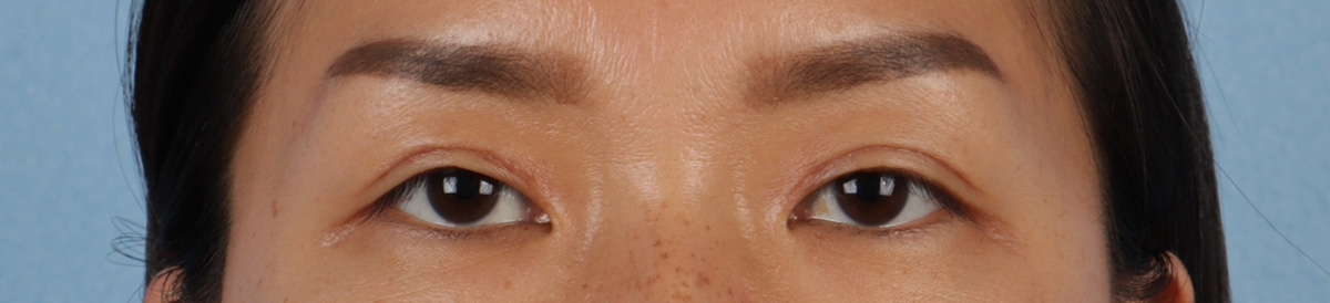 Blepharoplasty Before & After Gallery - Patient 871559 - Image 3