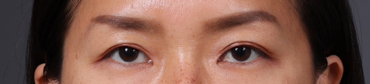 Blepharoplasty Before & After Gallery - Patient 871559 - Image 4