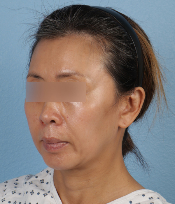 Mini Facelift Before & After Gallery - Patient 762717 - Image 1