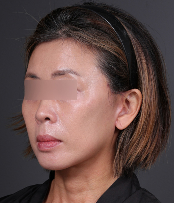 Mini Facelift Before & After Gallery - Patient 762717 - Image 2