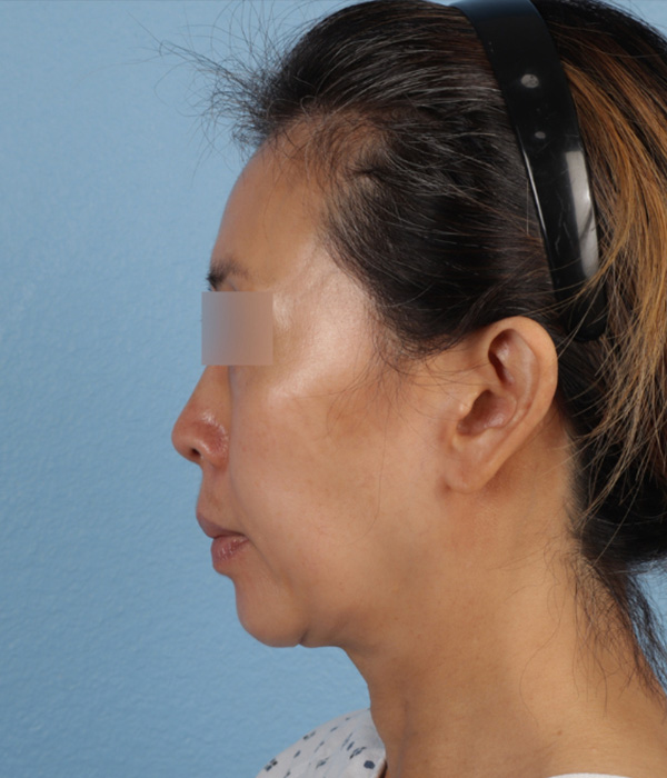 Mini Facelift Before & After Gallery - Patient 762717 - Image 3