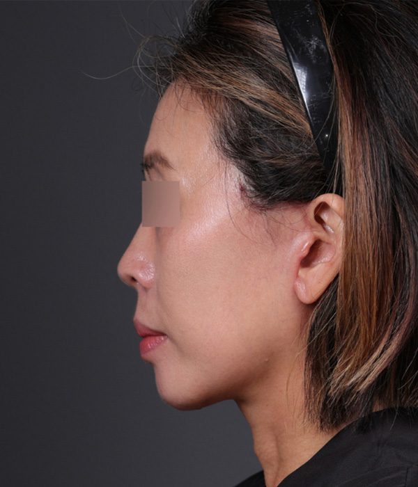 Mini Facelift Before & After Gallery - Patient 762717 - Image 4