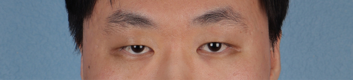 Blepharoplasty Before & After Gallery - Patient 402892 - Image 1