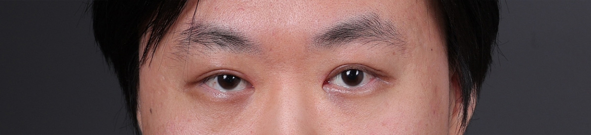 Blepharoplasty Before & After Gallery - Patient 402892 - Image 2