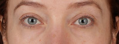Blepharoplasty Before & After Gallery - Patient 310704 - Image 1