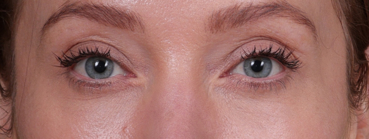 Blepharoplasty Before & After Gallery - Patient 310704 - Image 2