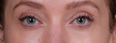 Blepharoplasty Before & After Gallery - Patient 310704 - Image 2