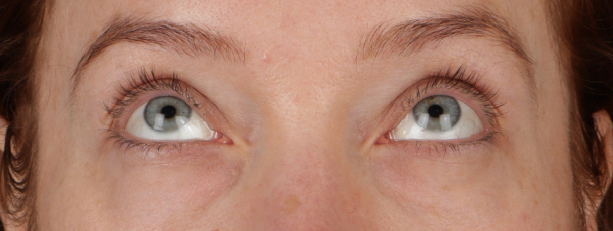 Blepharoplasty Before & After Gallery - Patient 310704 - Image 3