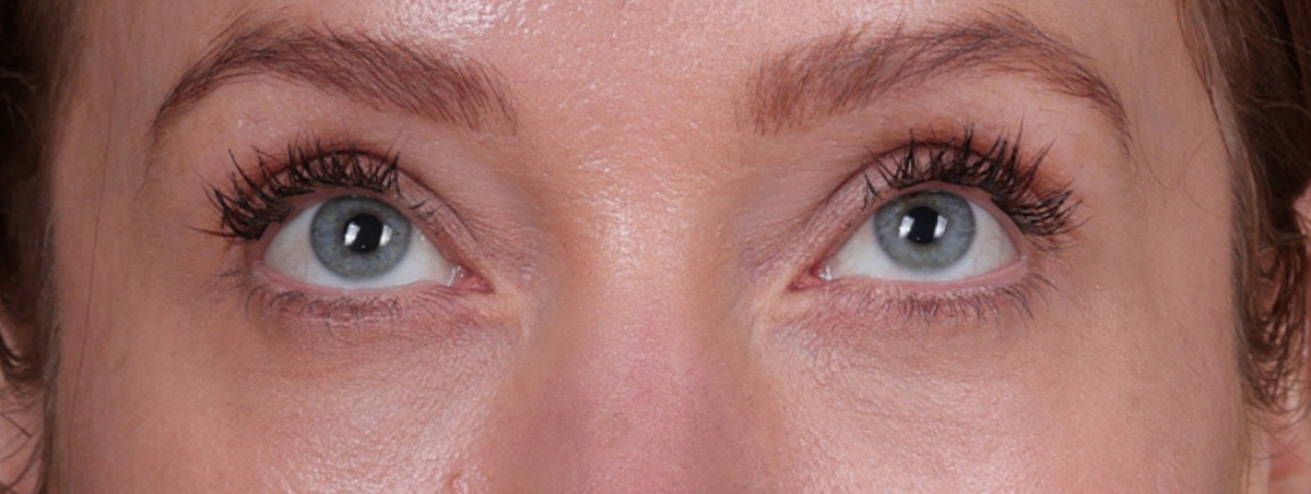 Blepharoplasty Before & After Gallery - Patient 310704 - Image 4