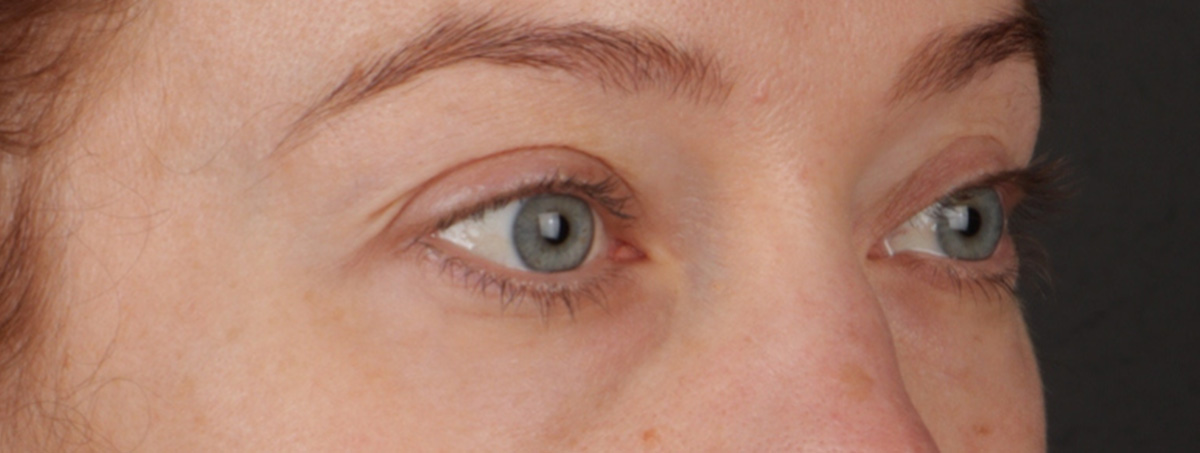 Blepharoplasty Before & After Gallery - Patient 310704 - Image 5