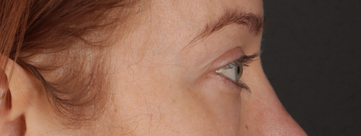 Blepharoplasty Before & After Gallery - Patient 310704 - Image 7