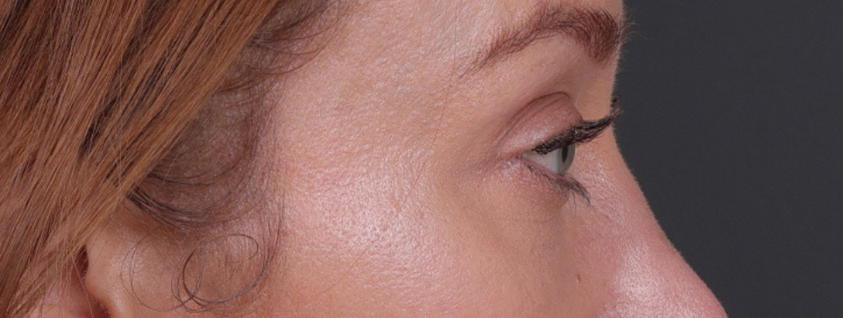 Blepharoplasty Before & After Gallery - Patient 310704 - Image 8