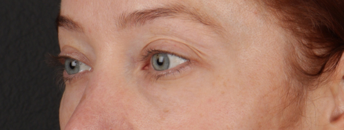 Blepharoplasty Before & After Gallery - Patient 310704 - Image 9