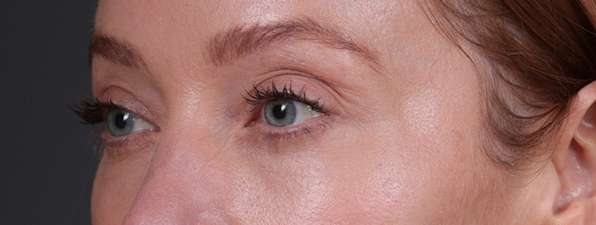 Blepharoplasty Before & After Gallery - Patient 310704 - Image 10
