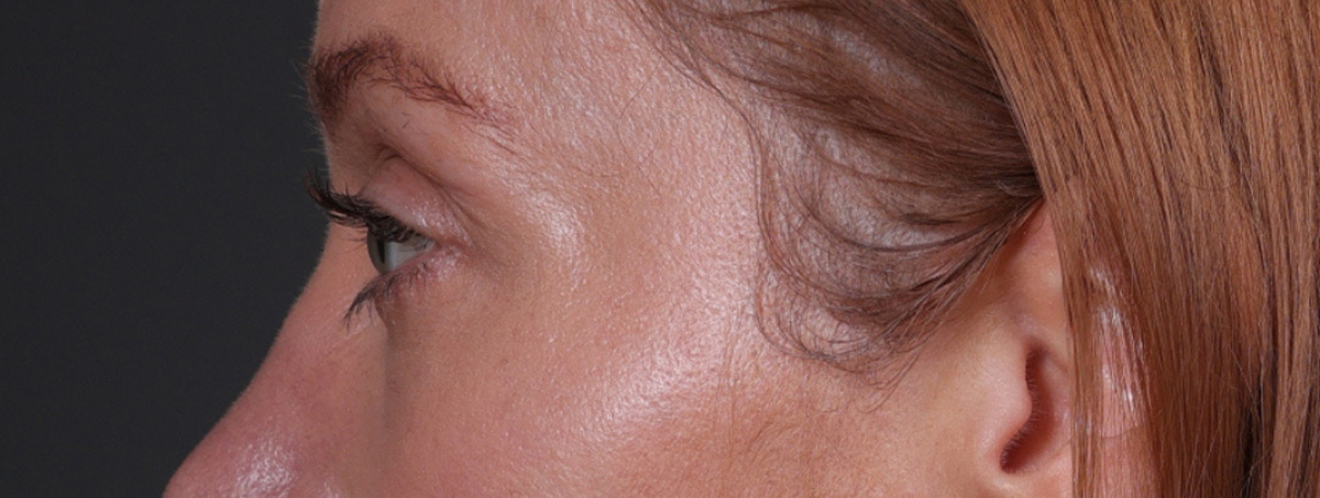 Blepharoplasty Before & After Gallery - Patient 310704 - Image 12