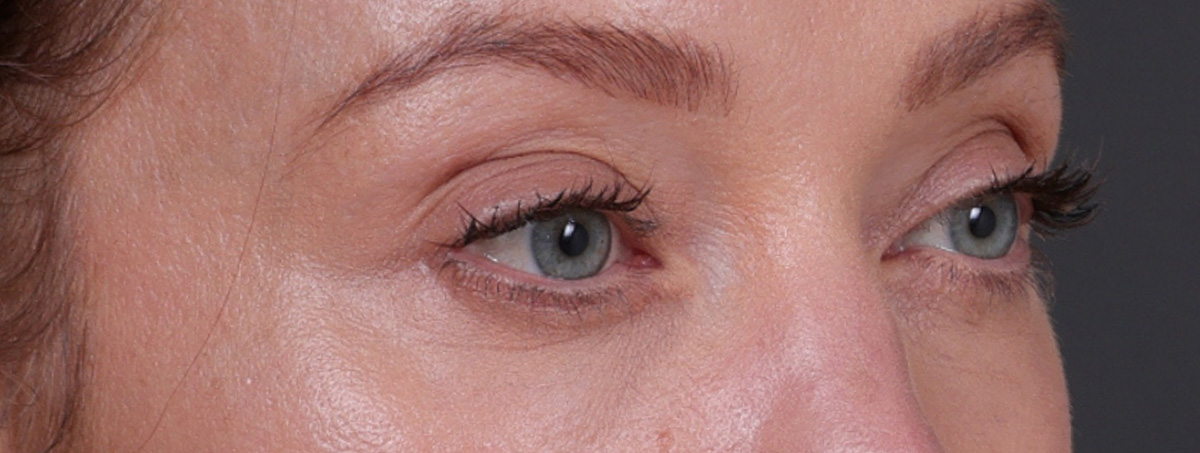 Blepharoplasty Before & After Gallery - Patient 310704 - Image 6