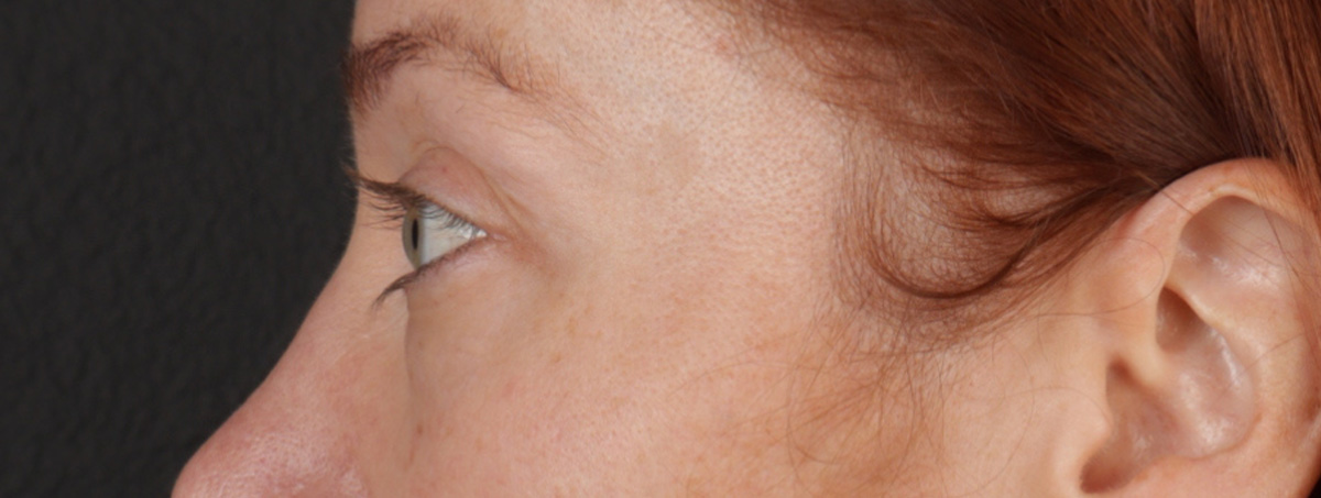 Blepharoplasty Before & After Gallery - Patient 310704 - Image 11