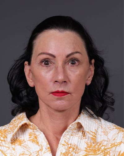 Facelift Before & After Gallery - Patient 199753 - Image 2