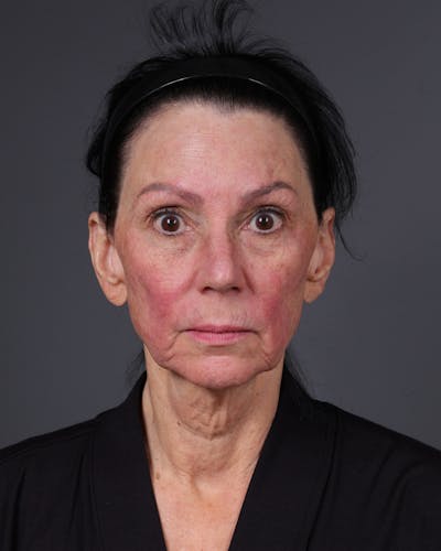 Facelift Before & After Gallery - Patient 199753 - Image 1