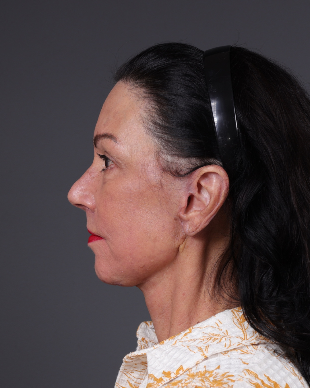 Facelift Before & After Gallery - Patient 199753 - Image 10
