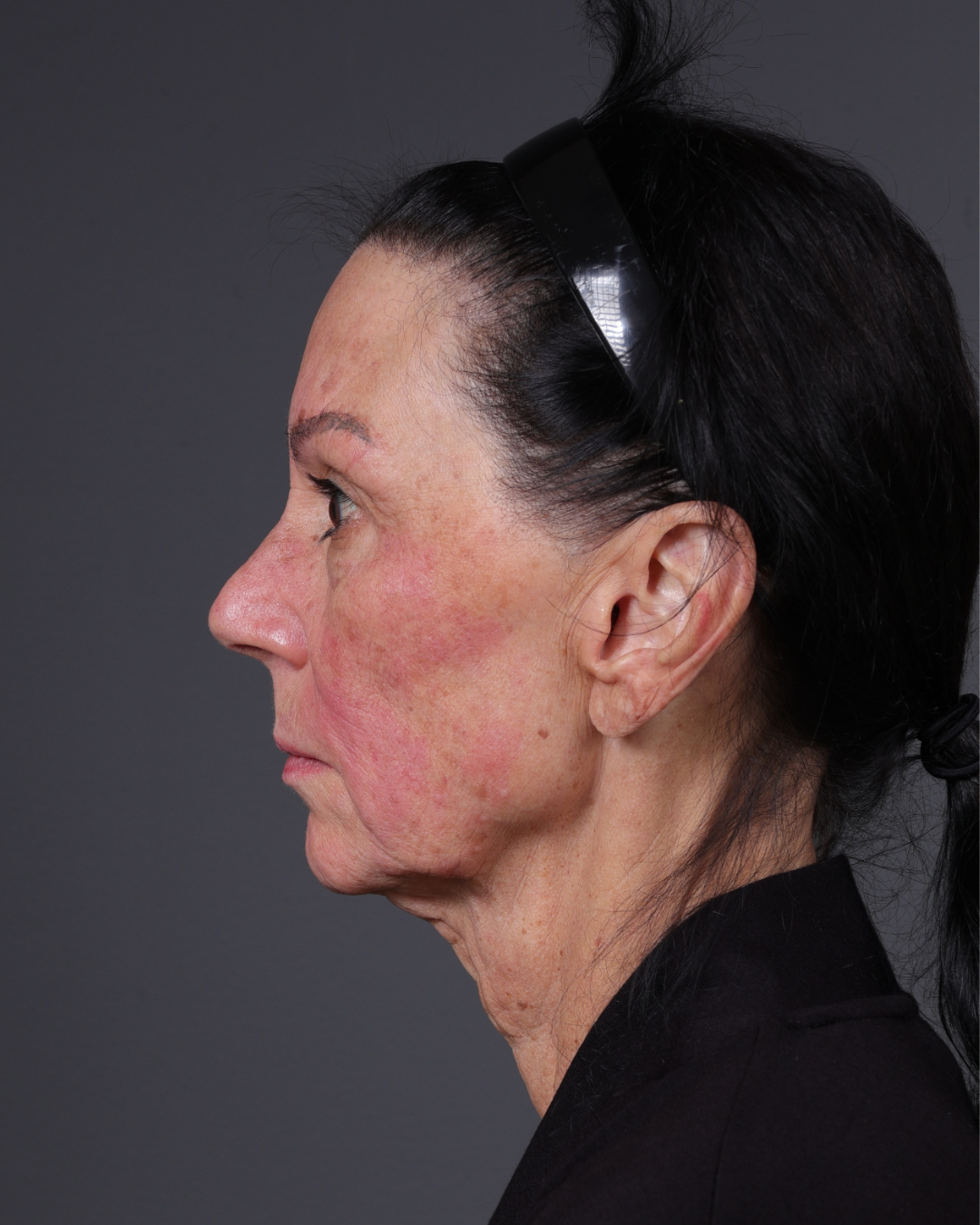 Facelift Before & After Gallery - Patient 199753 - Image 9