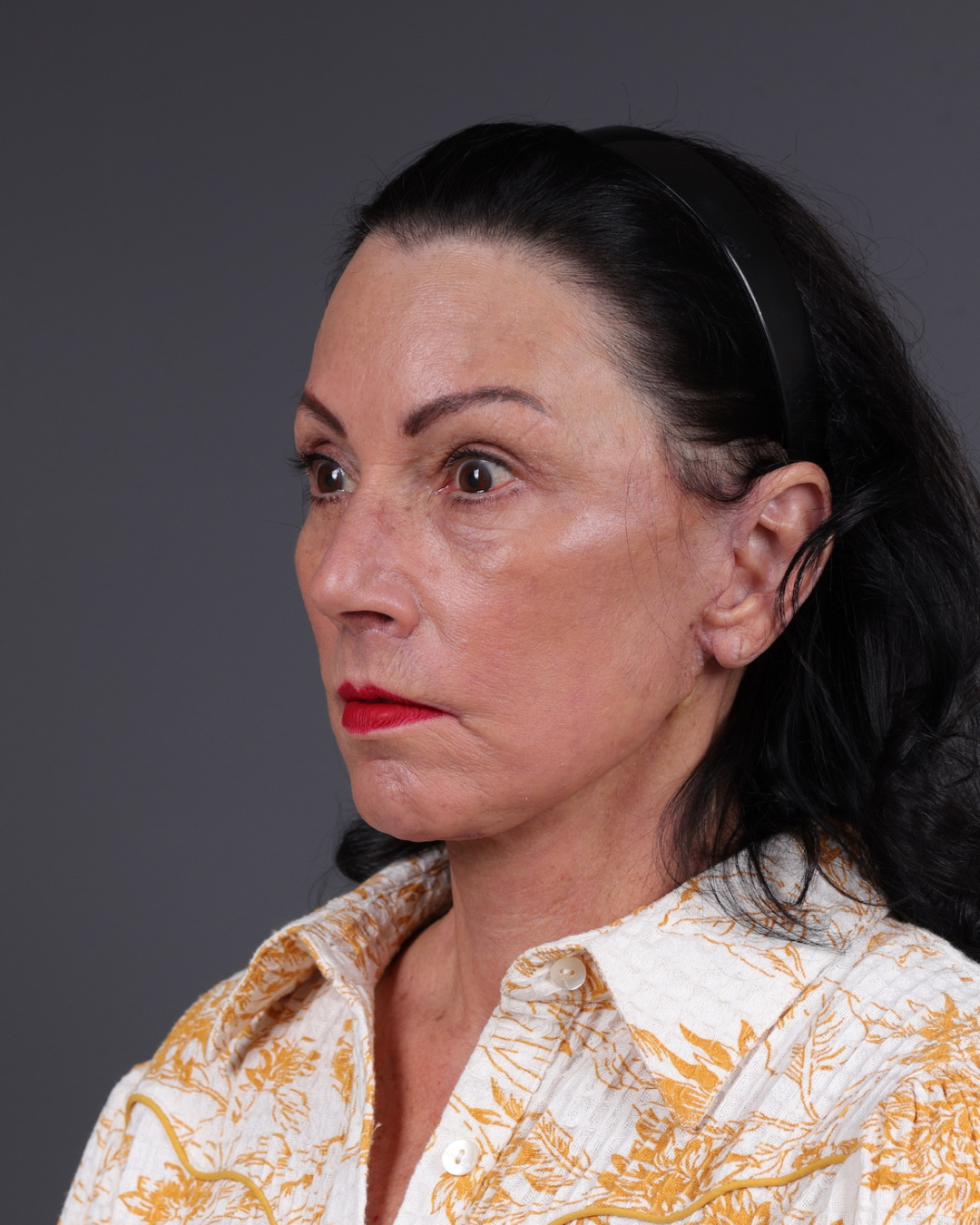 Facelift Before & After Gallery - Patient 199753 - Image 8