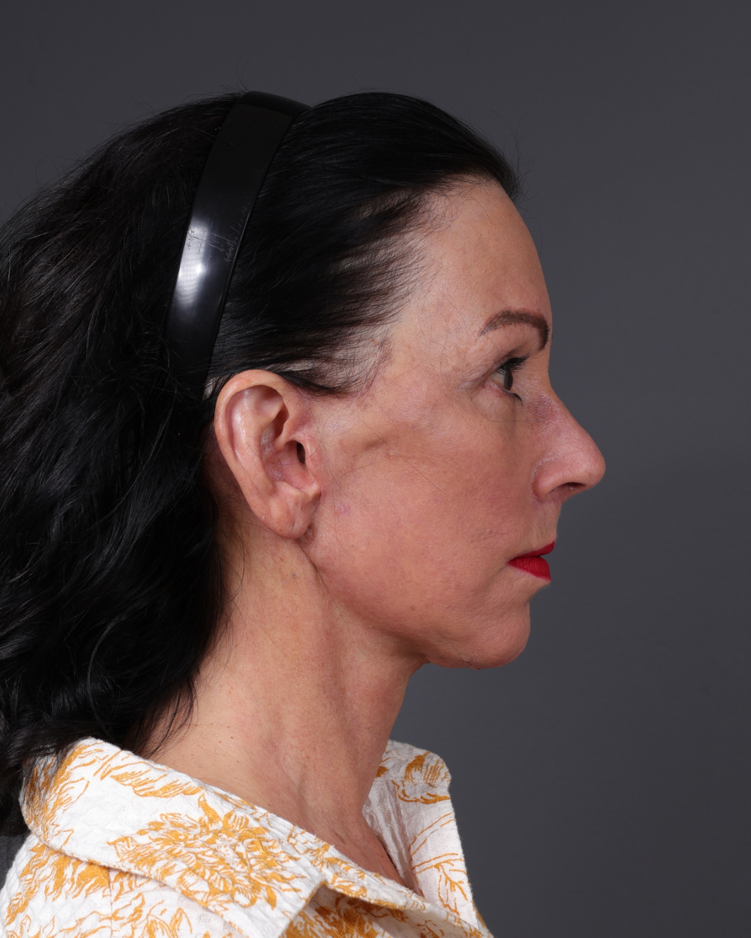 Facelift Before & After Gallery - Patient 199753 - Image 6