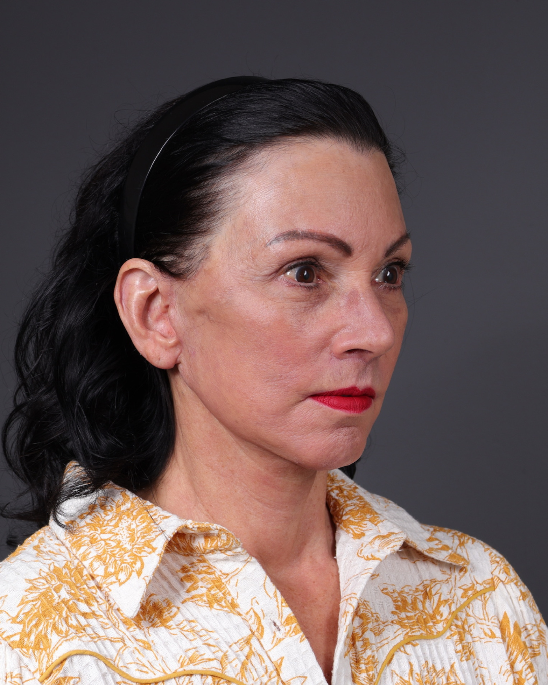 Facelift Before & After Gallery - Patient 199753 - Image 4